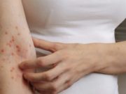 Кои се симптомите на шуга? Симптоми, начини на пренос и зошто се лекува целото семејство